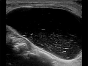This is an example of a geyser sign in a patient with a complete absent of the rotator cuff