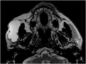 The mass proved to be a necrotic squamus cell carcinoma. Here is an MRI image of the same mass lesion.