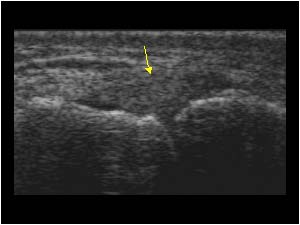 Thickened ulnar collateral ligament