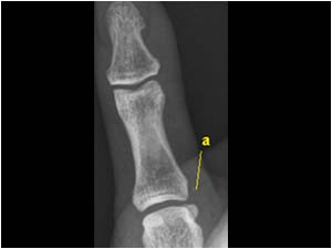 Traumatic lesions of the ulnar collateral ligament of the thumb