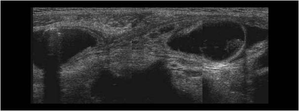 Dilatated small bowel and inguinal hernia with bowel loop longitudinal