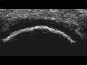 Lower pole of the patella and proximal patellar tendon transverse normal