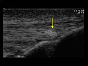 Distal patellar tendon with calcifications longitudinal