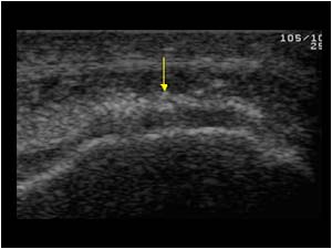 Distal patellar tendon with calcifications transverse