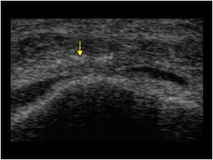 Distal patellar tendon with calcifications and small effusion in the bursa transverse