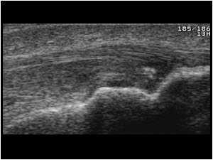 Distal patellar tendon with calcifications longitudinal right