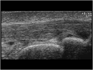 Distal patellar tendon longitudinal right