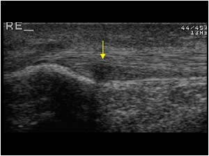 Proximal patellar tendon / jumpers knee longitudinal right