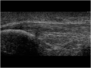 Proximal patellar tendon /jumpers knee longitudinal left