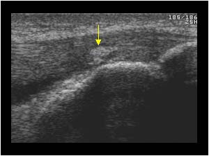 Tendon calcifications on the right side longitudinal