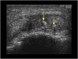 Tendon calcifications on the right side transverse