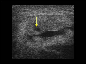 Small intratendinous rupture on the right side transverse