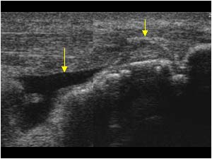 Tendon calcifications and fluid in the bursa on the right side longitudinal
