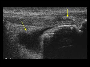 Fluid in the deep inftrapatellar bursa and tendon calcifications on the left side longitudinal