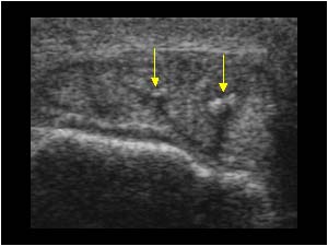 Tendon calcifications on the left side transverse