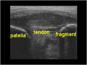 intact patellar tendon longitudinal