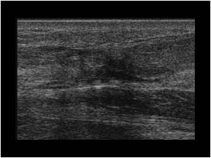 Full thickness achilles tendon rupture