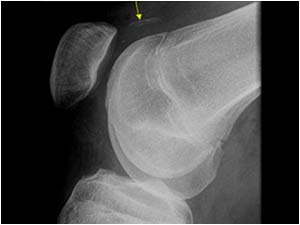 Dorsal side knee