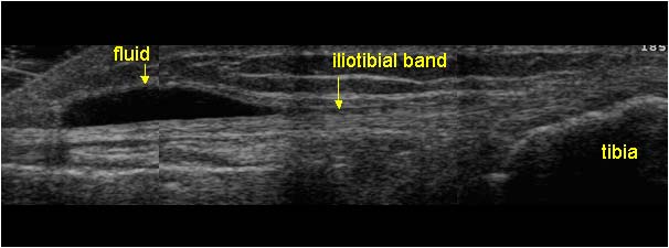 iliotibial band longitudinal