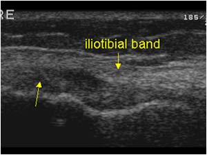 Longitudinal thickened iliotibial band