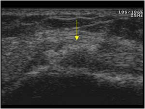 Thickened medial collateral ligament with calcifications transverse