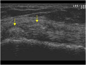 Thickened medial collateral ligament with calcifications longitudinal