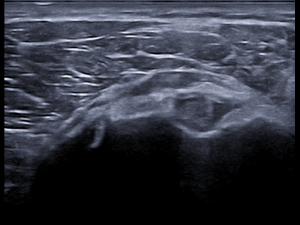 Transverse image proximal tendon/proximal part and bursa