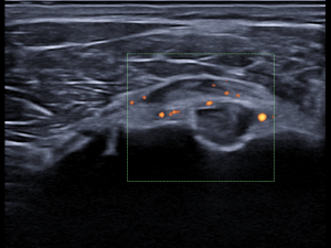 Transverse image proximal tendon/proximal part and bursa with power Doppler