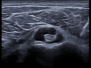 Transverse image proximal tendon/distal part