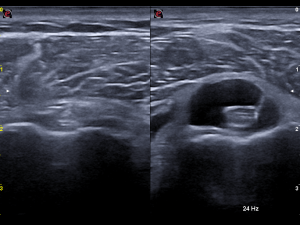 Transverse image left/right comparison proximal tendon/distal part 