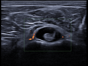Transverse image proximal tendon/distal part with power Doppler