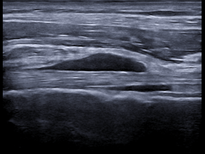 Longitudinal image proximal tendon and bursa
