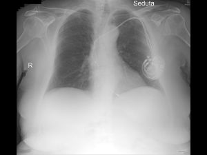 Case: COVID-19 Pneumonia