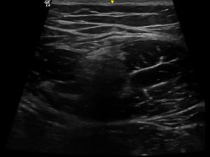 Rectus femoris muscle transverse with hyperechoic region