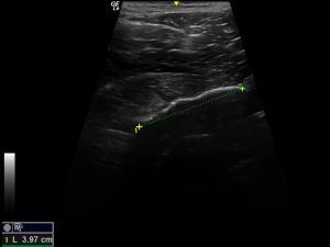 Indirect tendon measurement longitudinal (lateral approach)