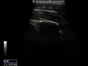 Indirect tendon measurement transverse (lateral approach)