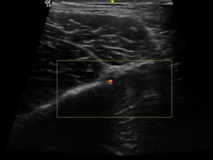 Indirect tendon longitudinal PD grade 0 (lateral approach)