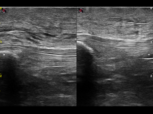 Longitudinal: left/right comparison proximal patellar tendon (image)