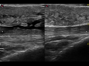 Longitudinal: left/right comparison superficial infrapatellar bursa and distal patellar tendon (image)