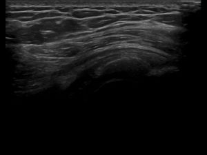 Longitudinal: calcification in SSP with mixed acoustic shades