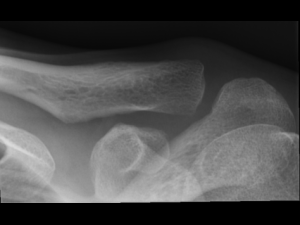 X-ray AC joint left