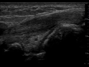 Longitudinal: ECRB tendon slightly distal of extensor compartment 2, at level of radiocarpal joint (18Mhz hockeystick transducer).