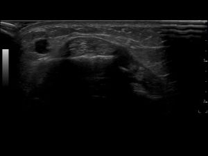Transverse: extensor compartment 2 at Listers tubercle level.