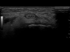 Transverse: ECRB tendon slightly distal of extensor compartment 2 (linear 15Mhz transducer).