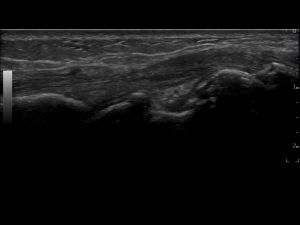 Longitudinal: ECRB tendon slightly distal of extensor compartment 2, at level of radiocarpal joint (linear 15Mhz transducer).