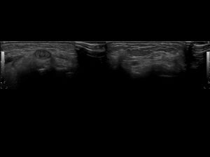 Transverse: left/right comparison of ECRB tendon (linear 15Mhz transducer).