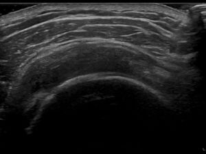 Transverse: supraspinatus tendon and SASD bursa