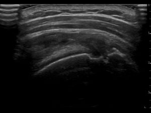 Longitudinal: supraspinatus tendon and SASD bursa