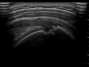 Longitudinal: supraspinatus tendon and SASD bursa