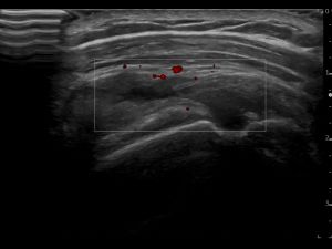Longitudinal: power Doppler of the supraspinatus tendon and SASD bursa